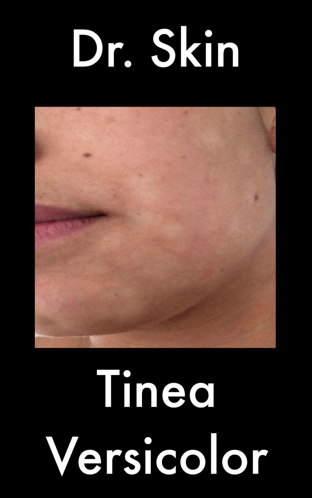 Big bigCover of Tinea Versicolor