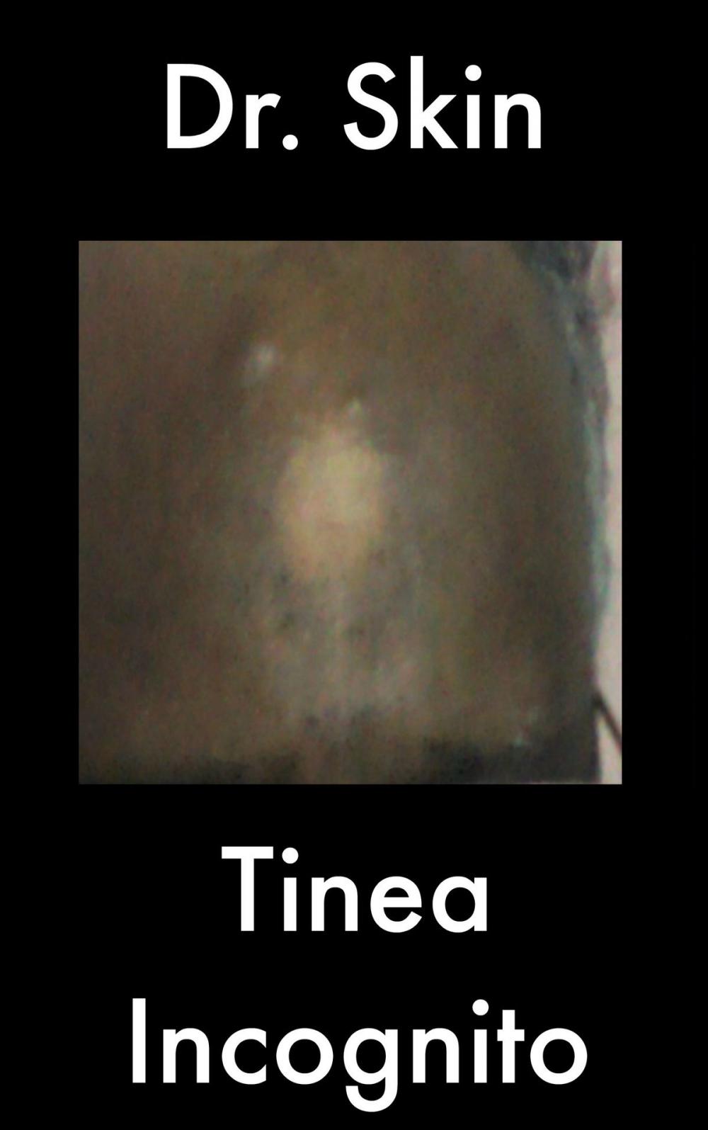 Big bigCover of Tinea Incognito