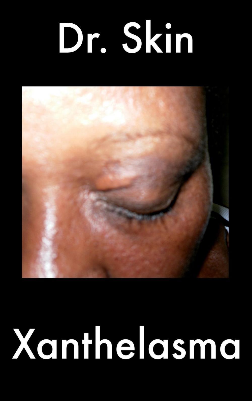 Big bigCover of Xanthelasma