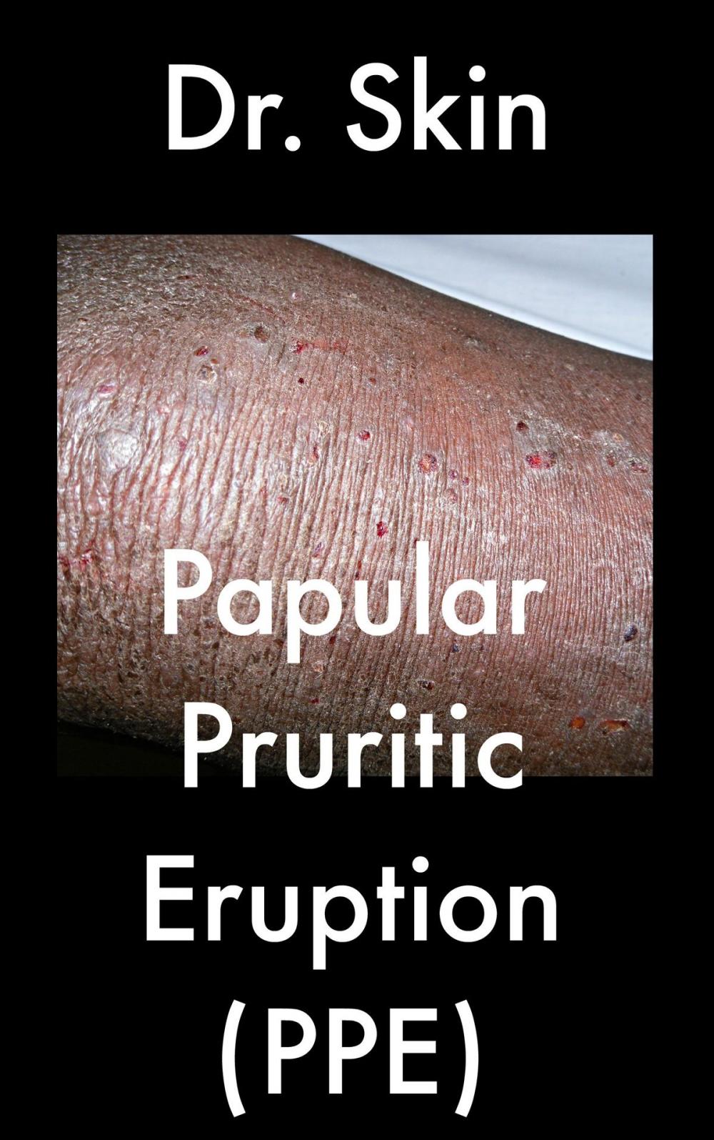 Big bigCover of Papular Pruritic Eruption