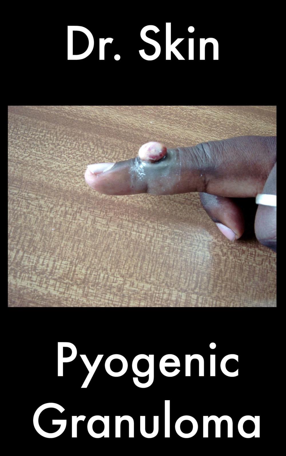 Big bigCover of Pyogenic Granuloma