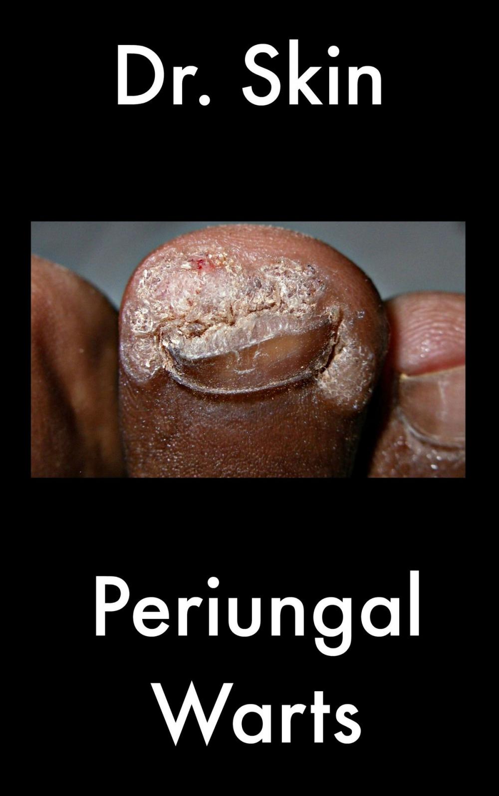 Big bigCover of Periungal Warts