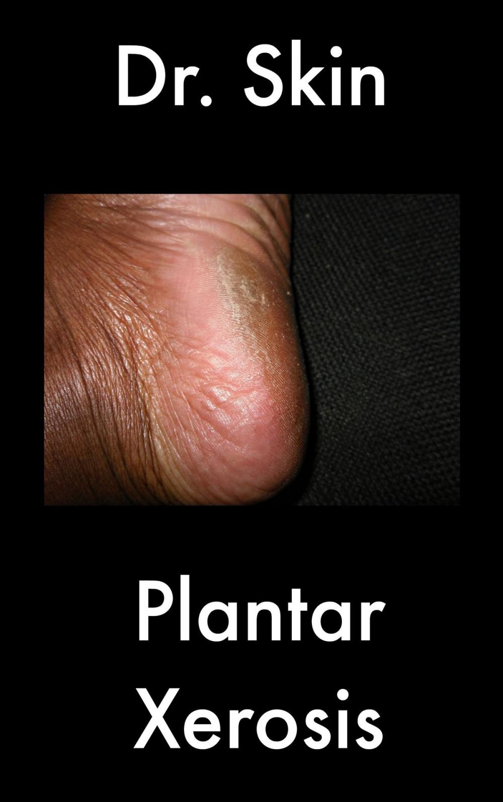 Big bigCover of Plantar Xerosis