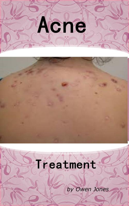 Cover of the book Acne Treatment by Owen Jones, Megan Publishing Services