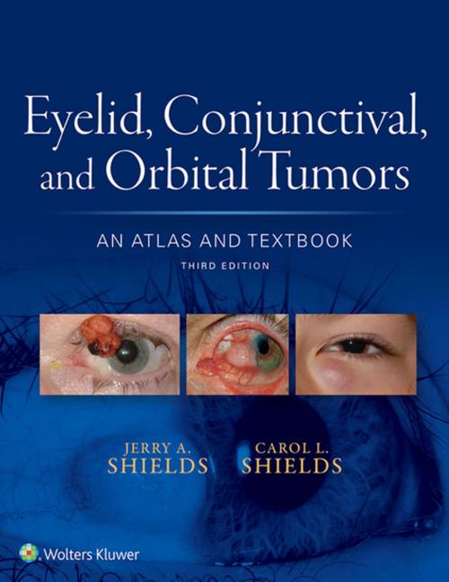 Cover of the book Eyelid, Conjunctival, and Orbital Tumors: An Atlas and Textbook by Jerry A. Shields, Carol L. Shields, Wolters Kluwer Health