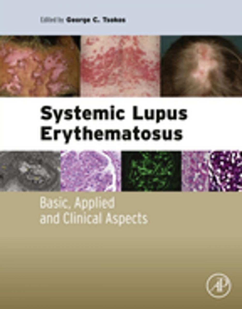 Big bigCover of Systemic Lupus Erythematosus