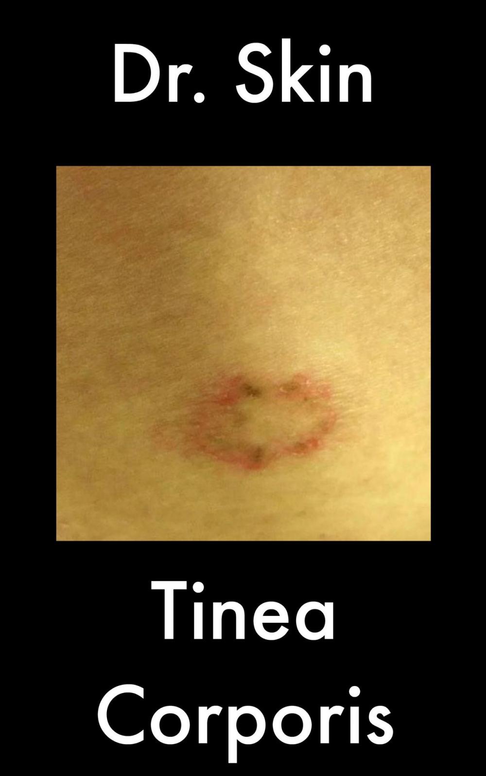 Big bigCover of Tinea Corporis