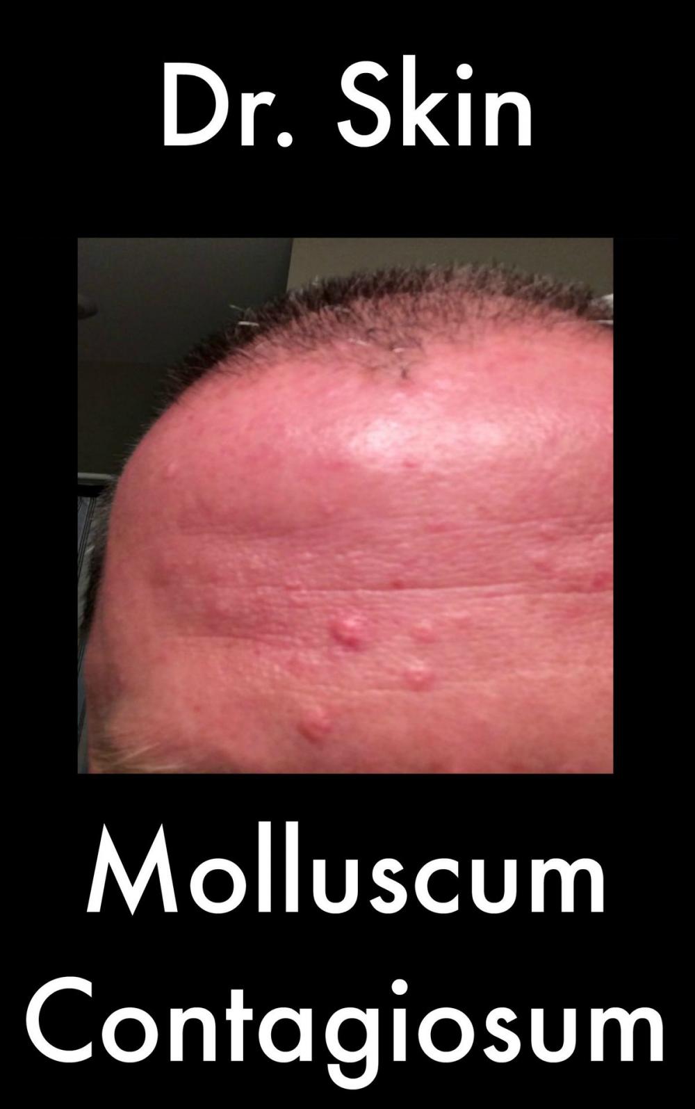 Big bigCover of Molluscum Contagiosum