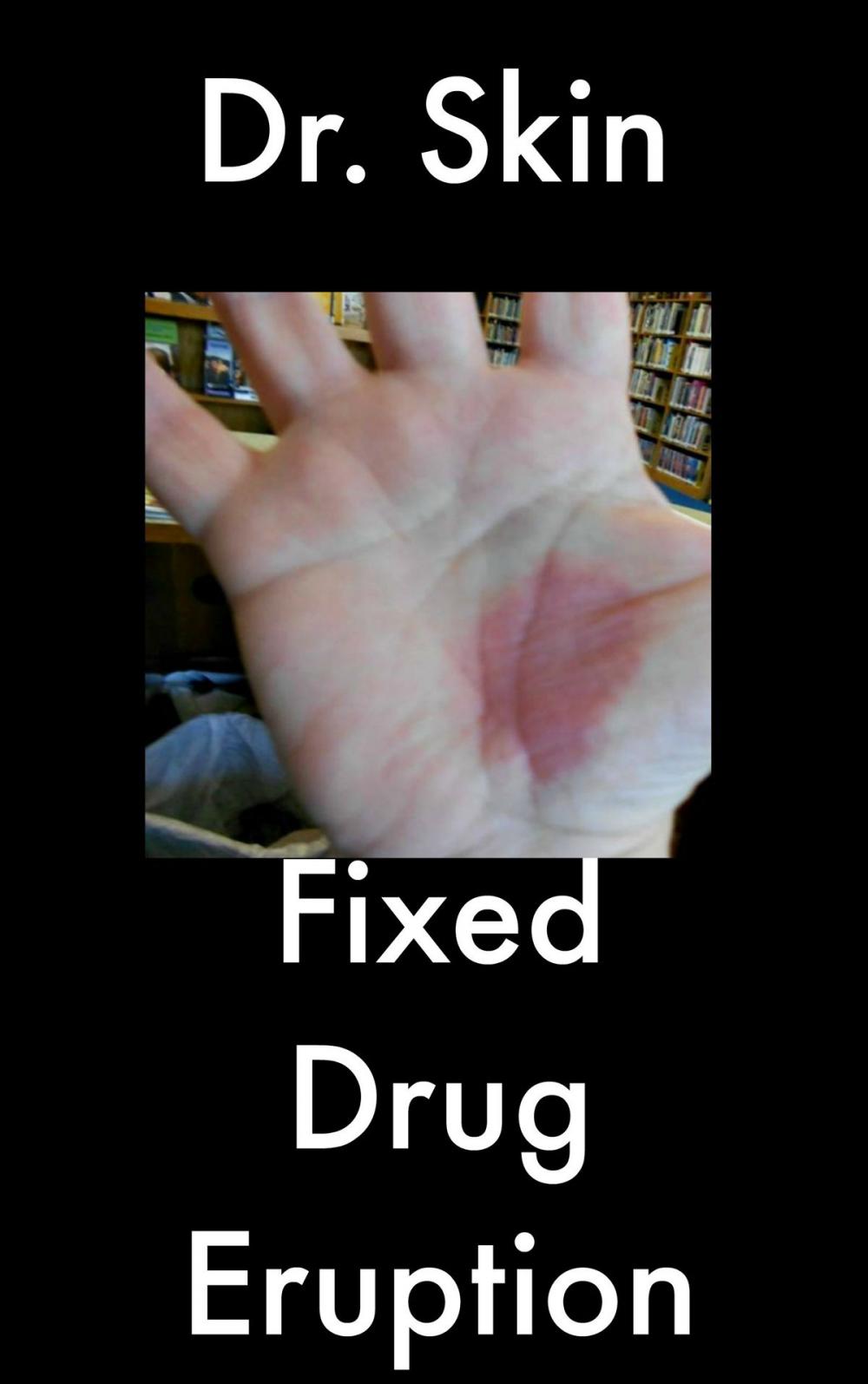 Big bigCover of Fixed Drug Eruption