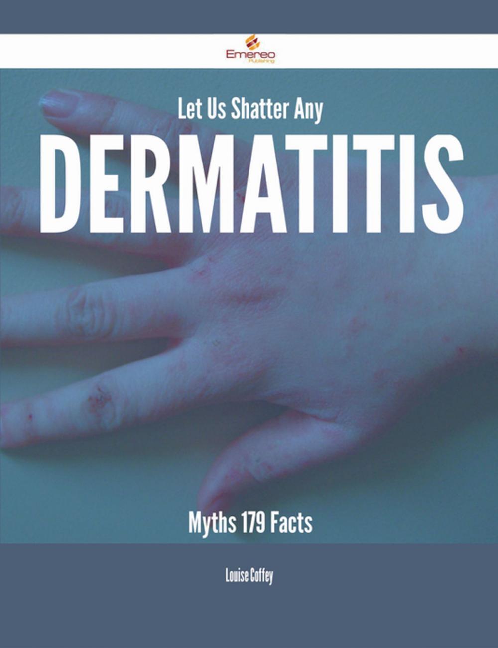 Big bigCover of Let Us Shatter Any Dermatitis Myths - 179 Facts