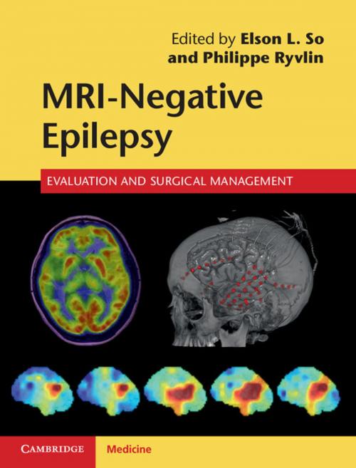 Cover of the book MRI-Negative Epilepsy by , Cambridge University Press