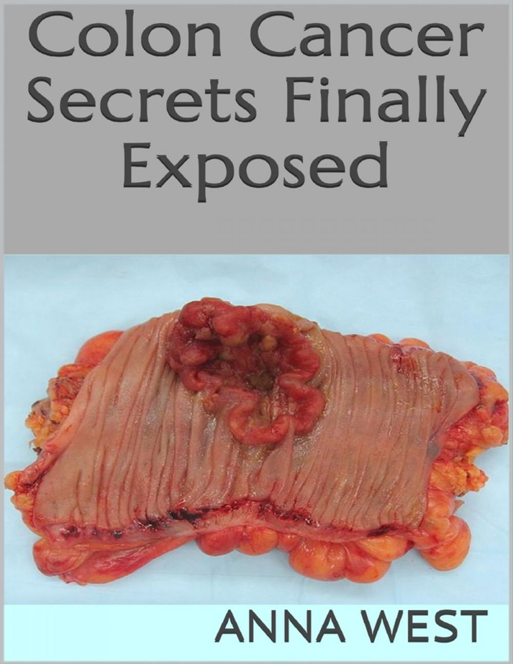 Big bigCover of Colon Cancer Secrets Finally Exposed