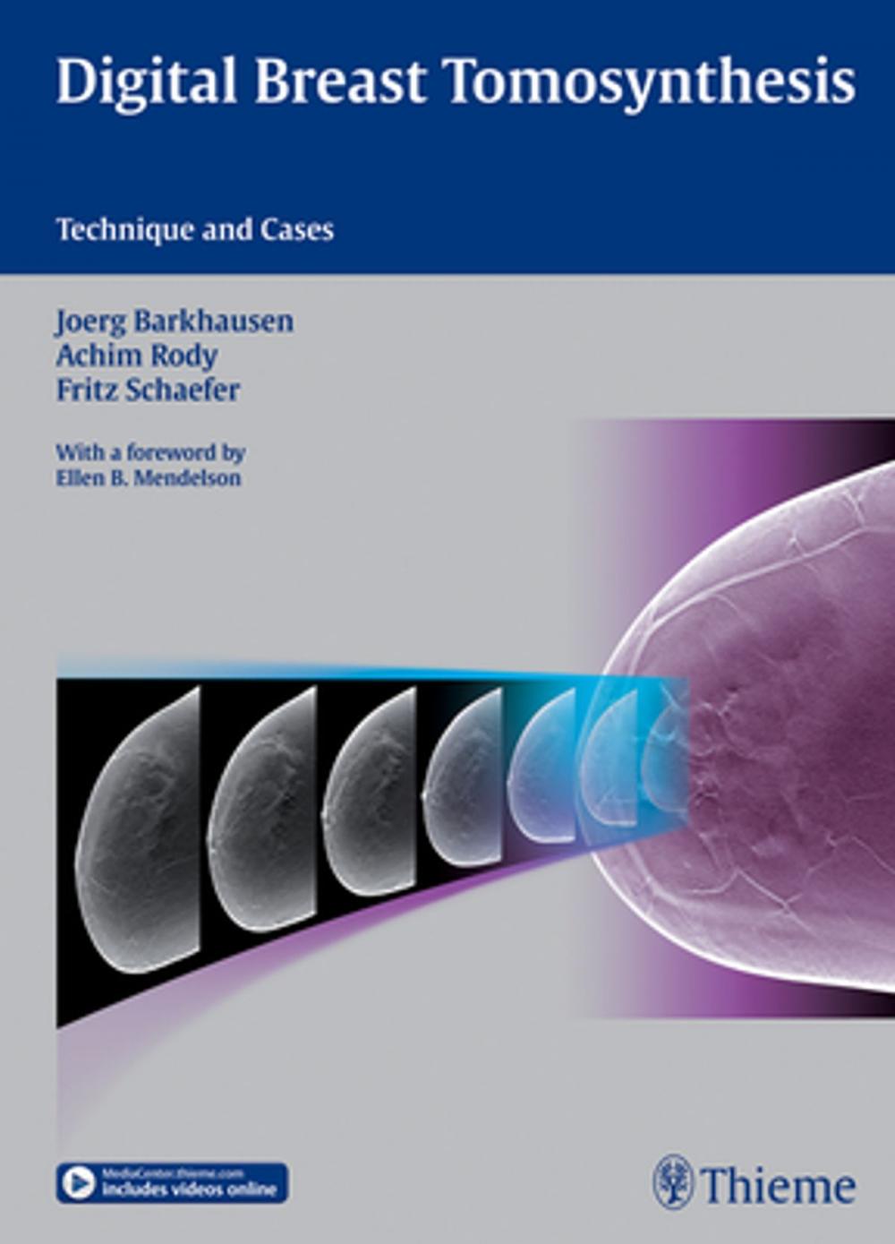 Big bigCover of Digital Breast Tomosynthesis