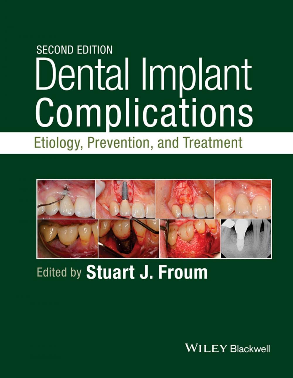 Big bigCover of Dental Implant Complications