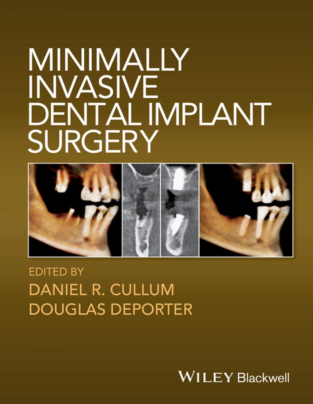 Big bigCover of Minimally Invasive Dental Implant Surgery