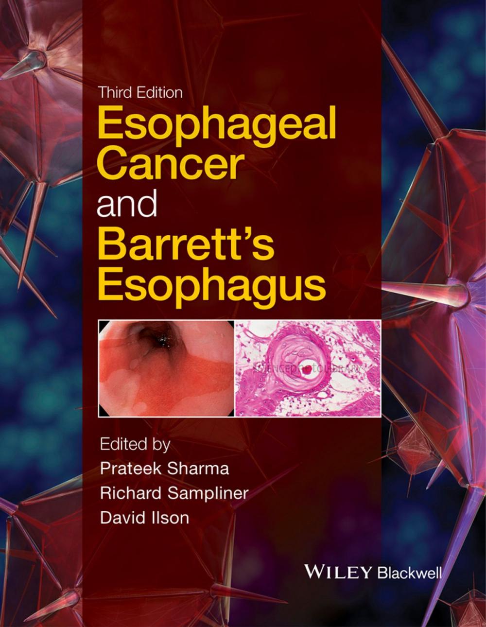 Big bigCover of Esophageal Cancer and Barrett's Esophagus