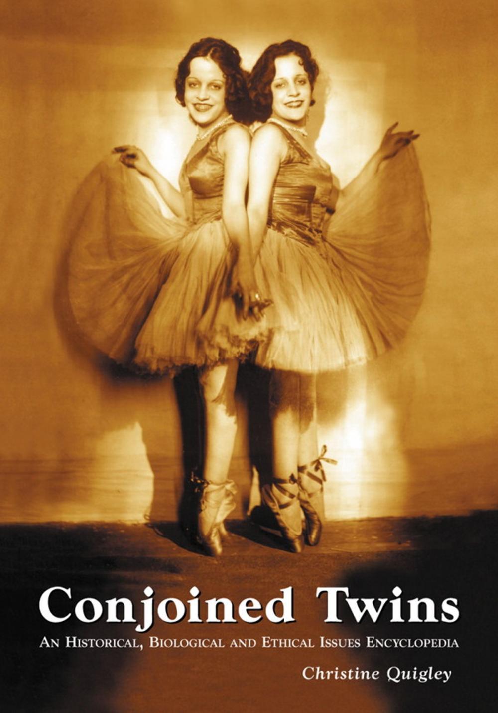 Big bigCover of Conjoined Twins