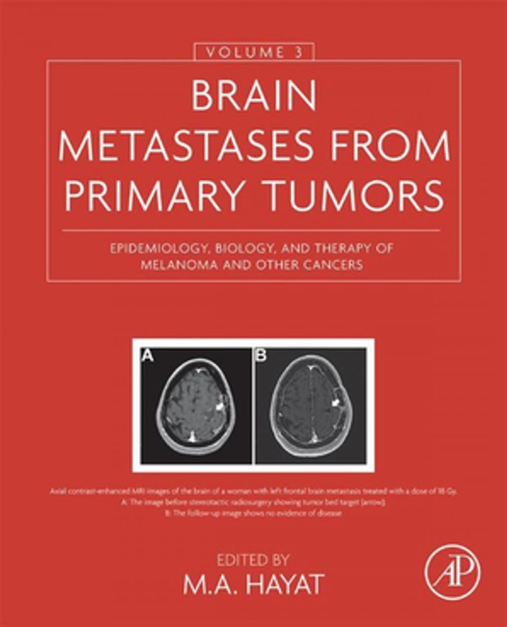 Big bigCover of Brain Metastases from Primary Tumors, Volume 3
