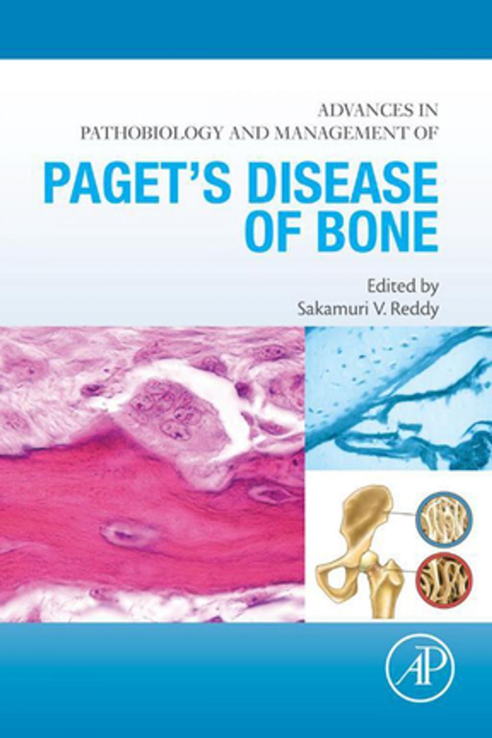 Big bigCover of Advances in Pathobiology and Management of Paget’s Disease of Bone