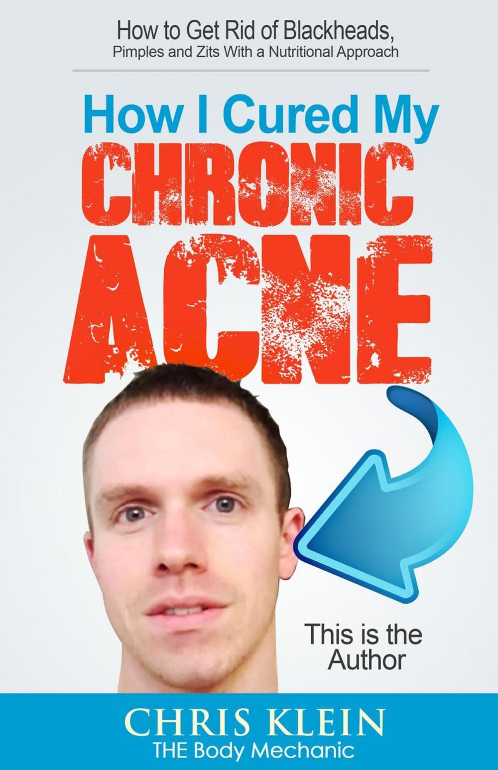 Big bigCover of How I Cured My Chronic Acne: How to Get Rid of Blackheads, Pimples and Zits With a Nutritional Approach