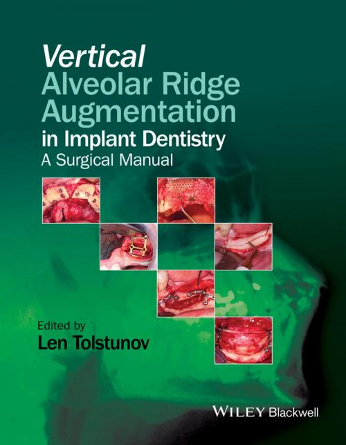 Cover of the book Vertical Alveolar Ridge Augmentation in Implant Dentistry by , Wiley