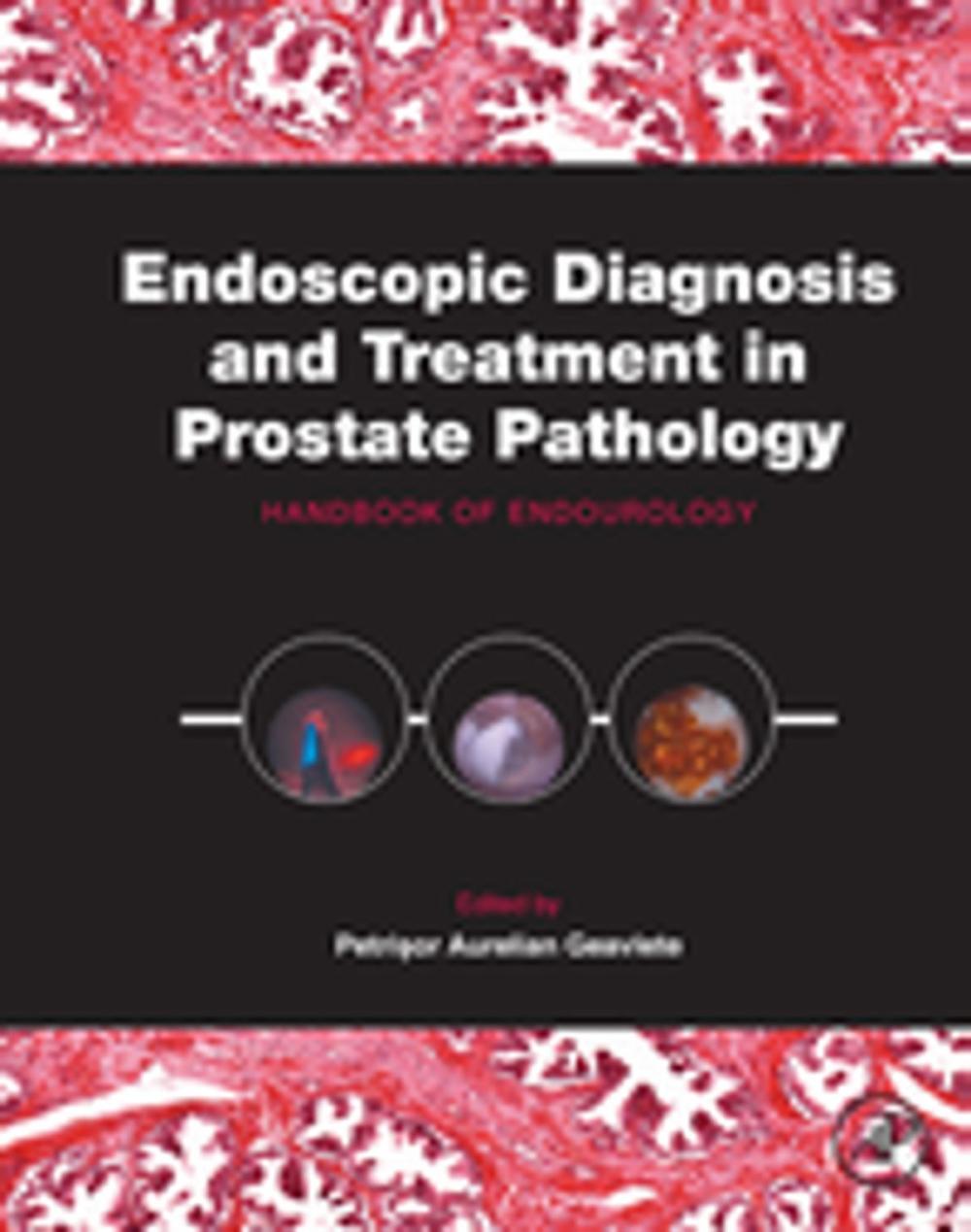 Big bigCover of Endoscopic Diagnosis and Treatment in Prostate Pathology