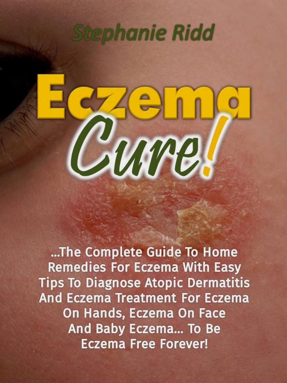 Big bigCover of Eczema Cure!: The Complete Guide To Home Remedies For Eczema With Easy Tips To Diagnose Atopic Dermatitis And Eczema Treatment For Eczema On Hands, Eczema On Face And Baby Eczema... To Be Eczema Free