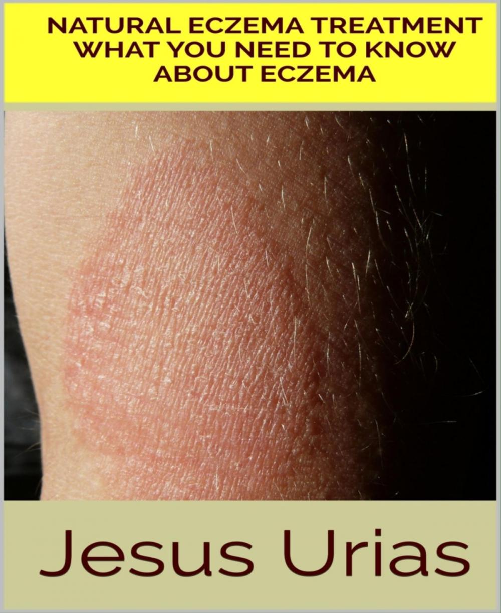 Big bigCover of Natural Eczema Treatment