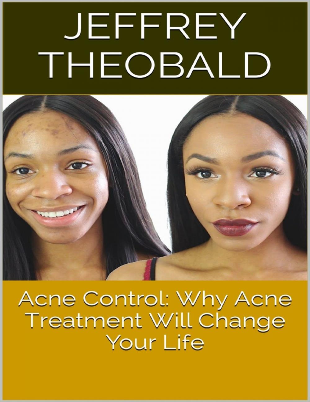 Big bigCover of Acne Control: Why Acne Treatment Will Change Your Life