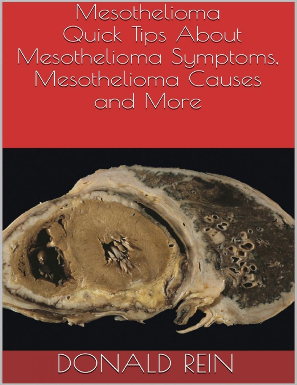 Big bigCover of Mesothelioma: Quick Tips About Mesothelioma Symptoms, Mesothelioma Causes and More