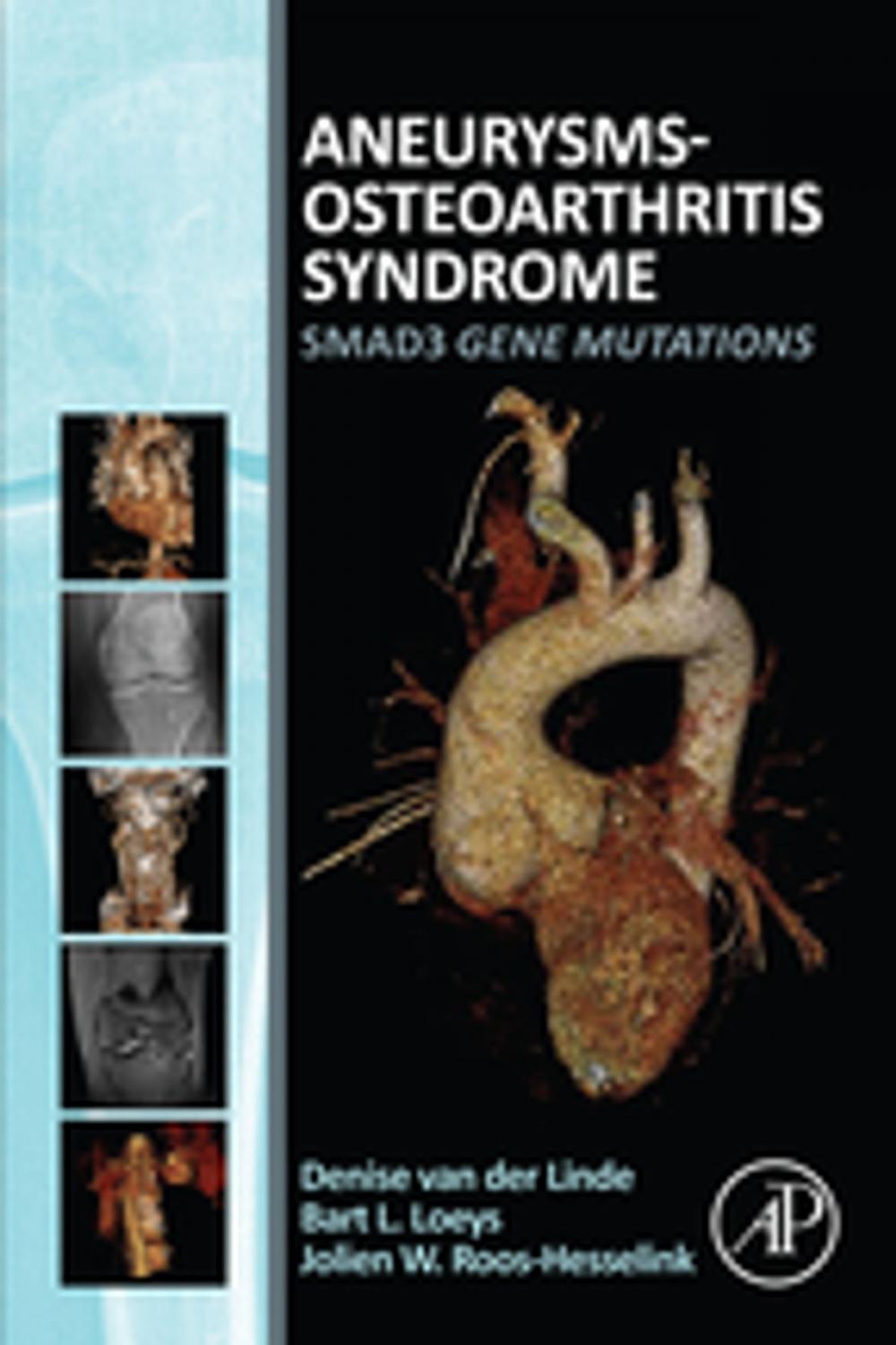 Big bigCover of Aneurysms-Osteoarthritis Syndrome