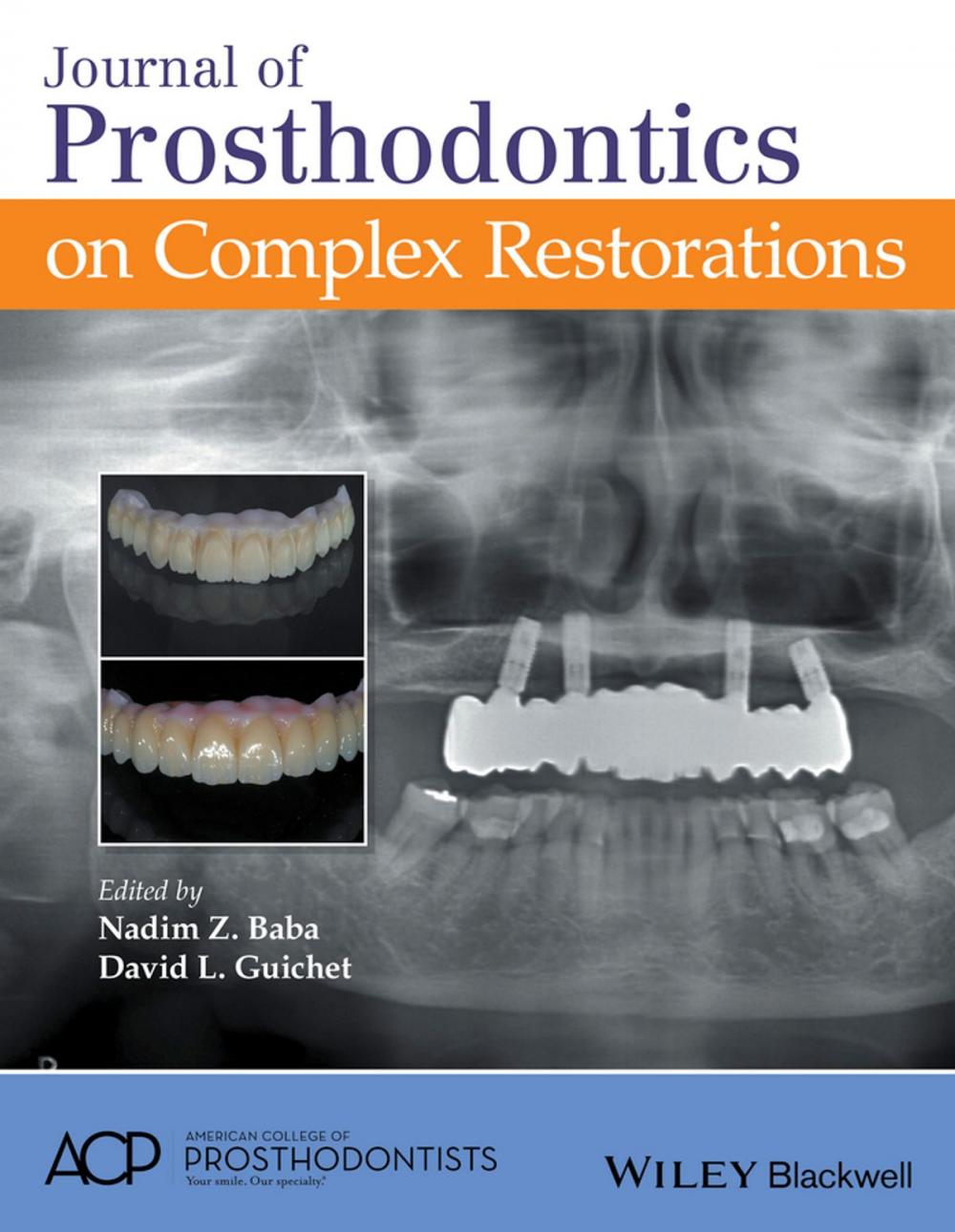 Big bigCover of Journal of Prosthodontics on Complex Restorations