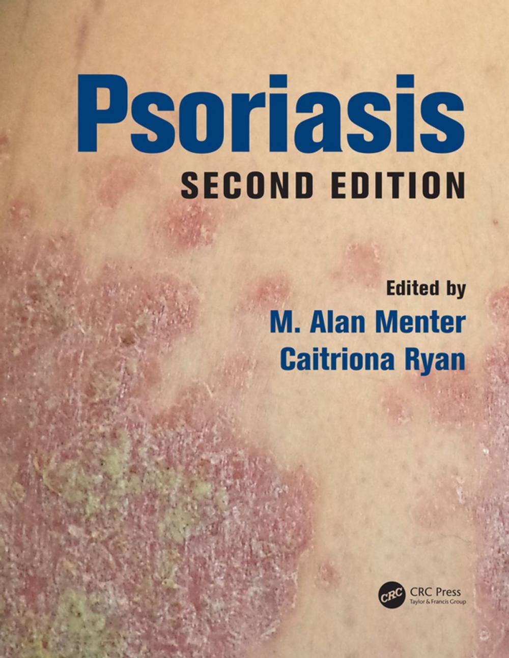 Big bigCover of Psoriasis