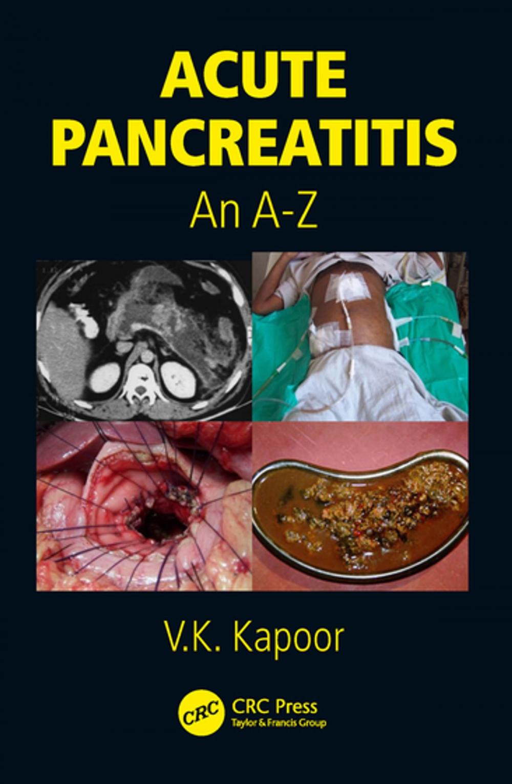 Big bigCover of Acute Pancreatitis