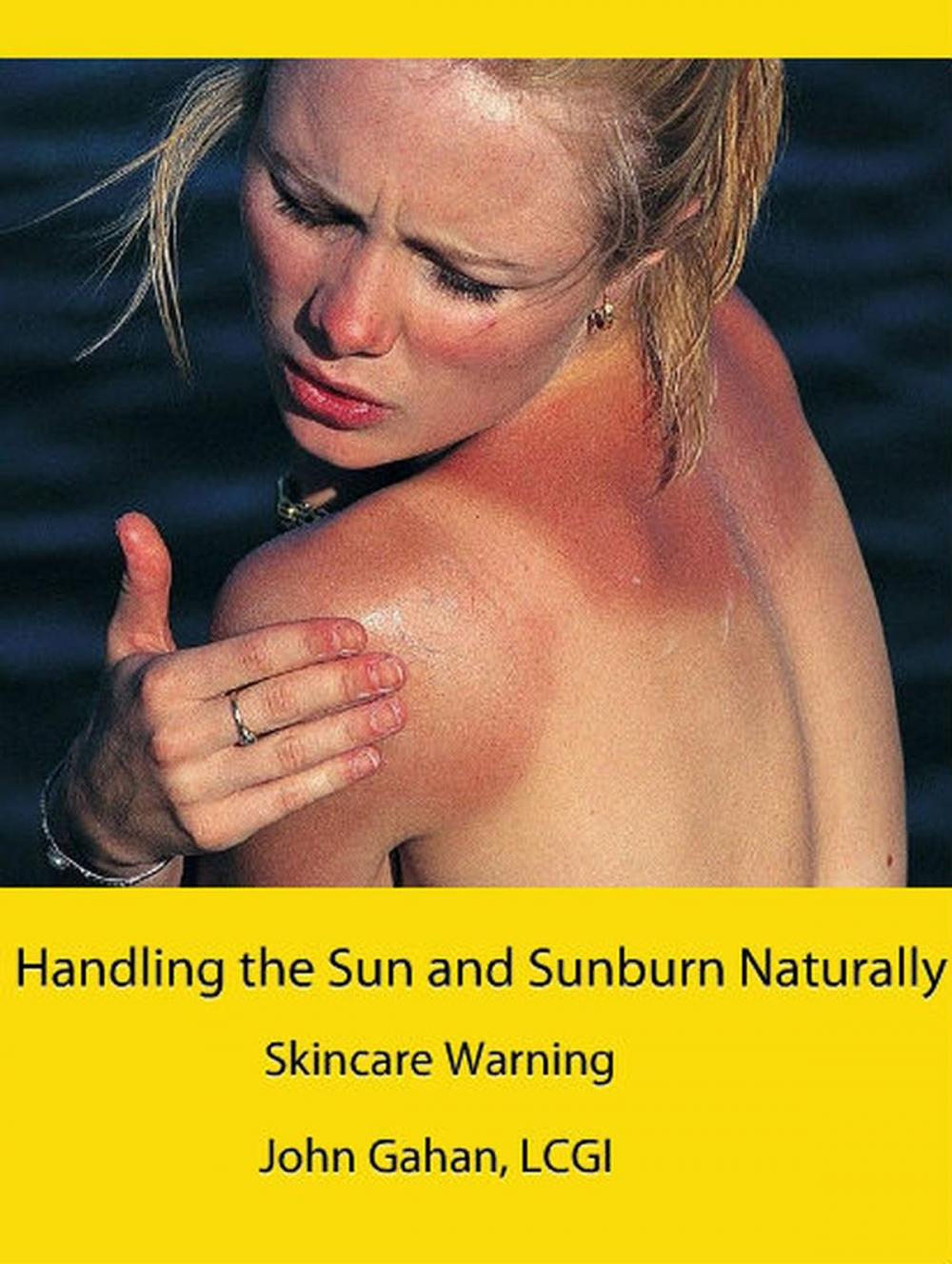 Big bigCover of Handling the Sun and Sunburn Naturally: Skincare Warning