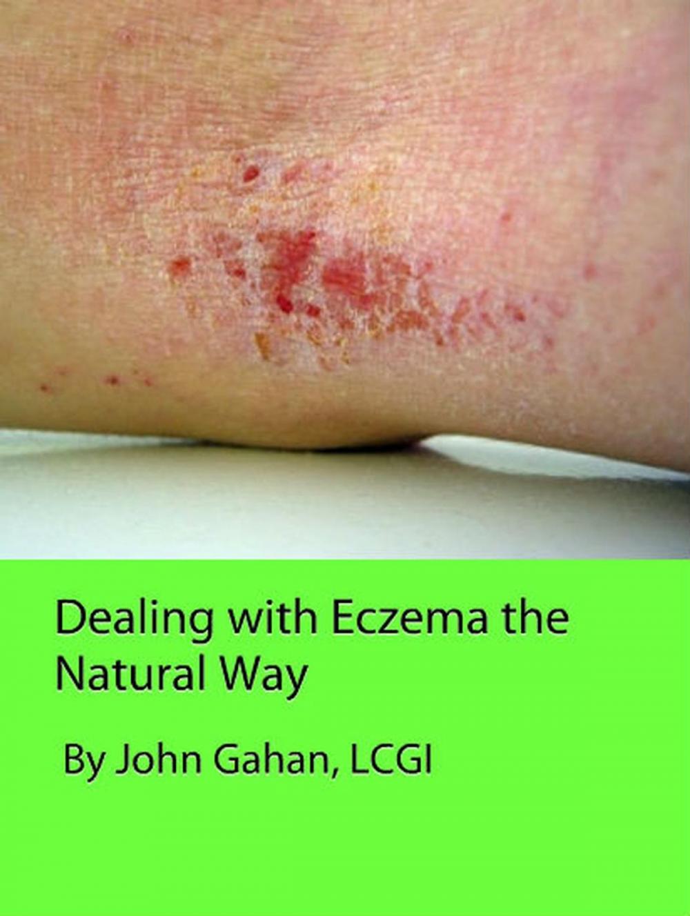 Big bigCover of Dealing with Eczema the Natural Way