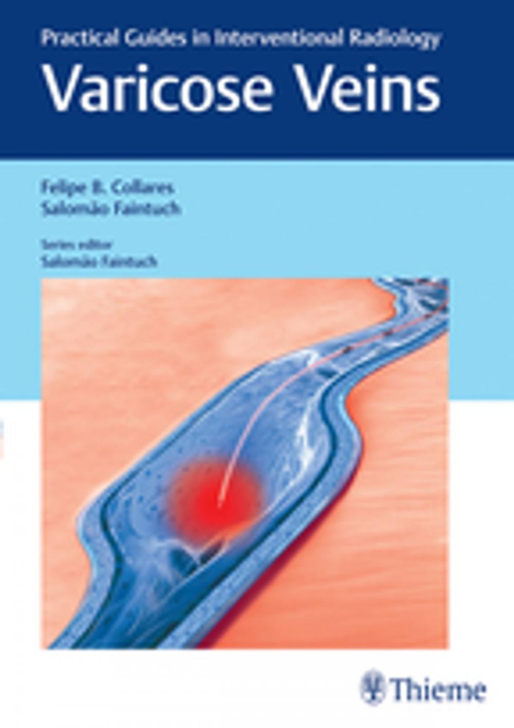 Big bigCover of Varicose Veins