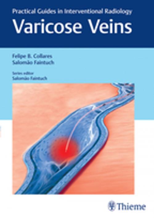 Cover of the book Varicose Veins by Felipe Collares, Salomao Faintuch, Thieme