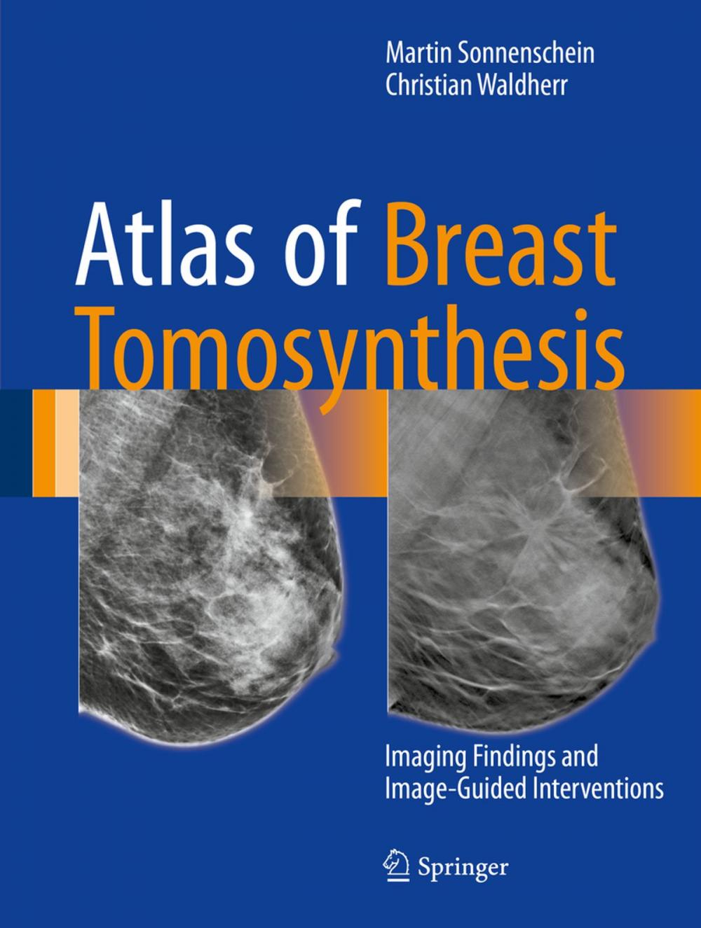 Big bigCover of Atlas of Breast Tomosynthesis