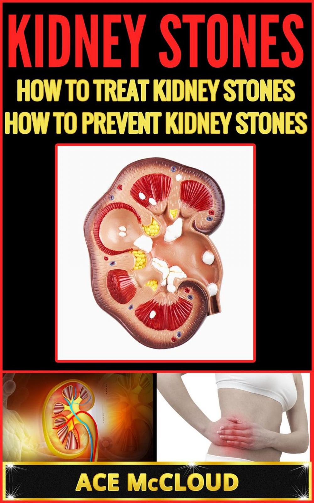 Big bigCover of Kidney Stones: How To Treat Kidney Stones: How To Prevent Kidney Stones