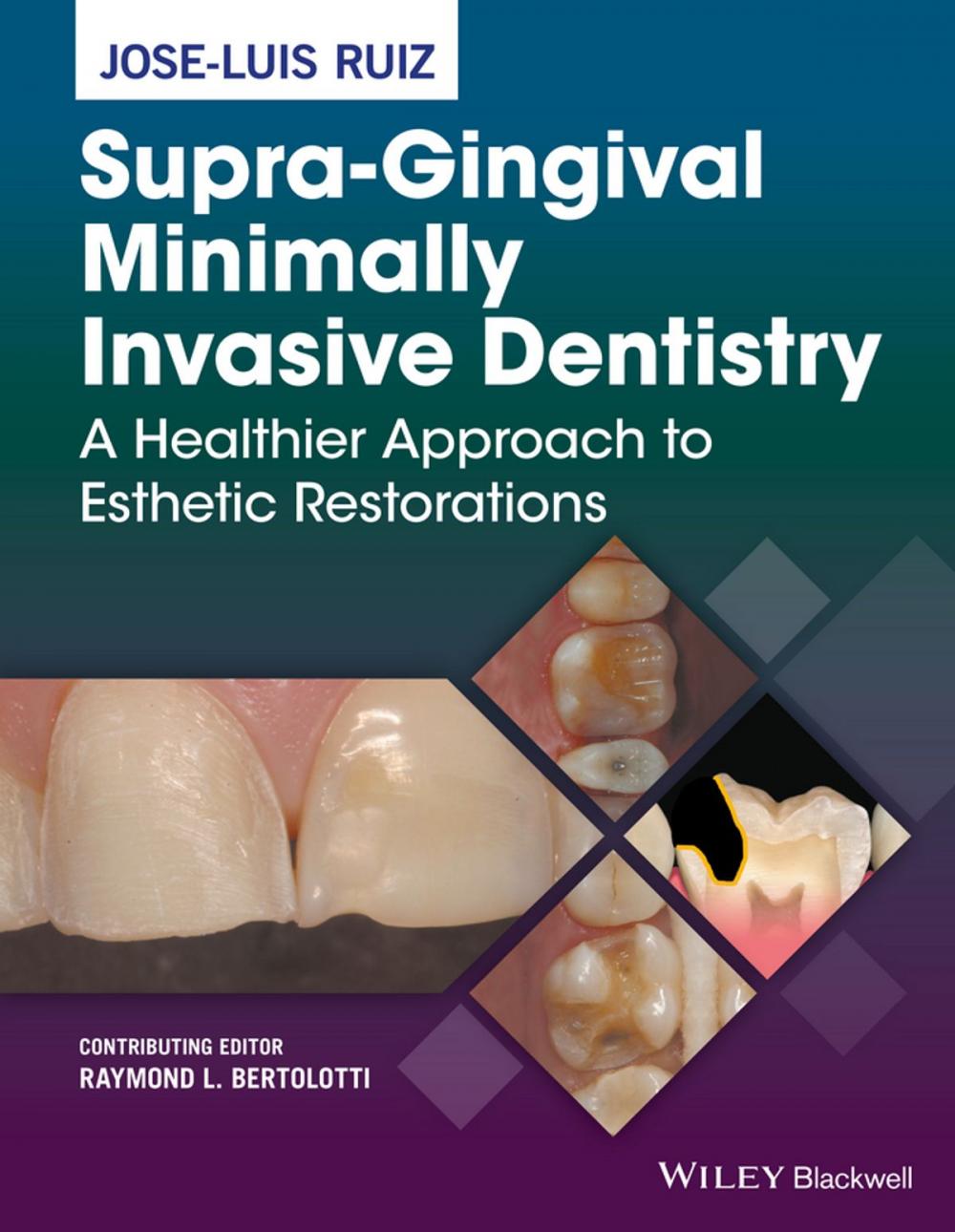 Big bigCover of Supra-Gingival Minimally Invasive Dentistry