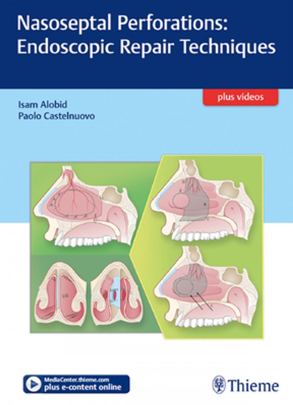 Big bigCover of Nasoseptal Perforations: Endoscopic Repair Techniques