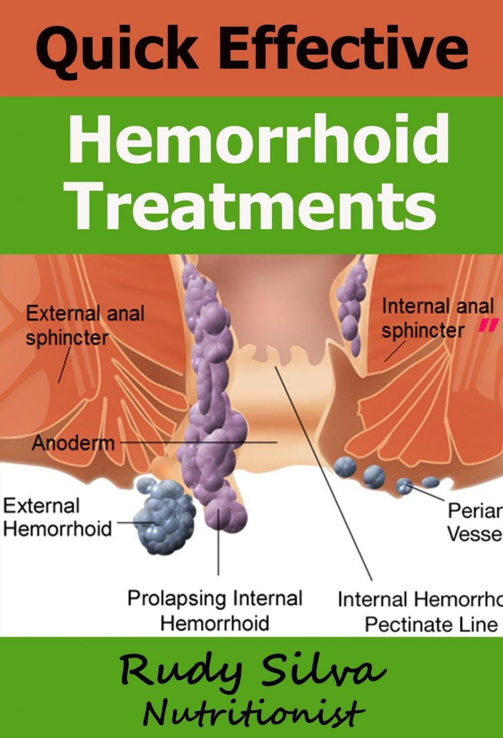 Big bigCover of Quick Effective Hemorrhoid Treatments