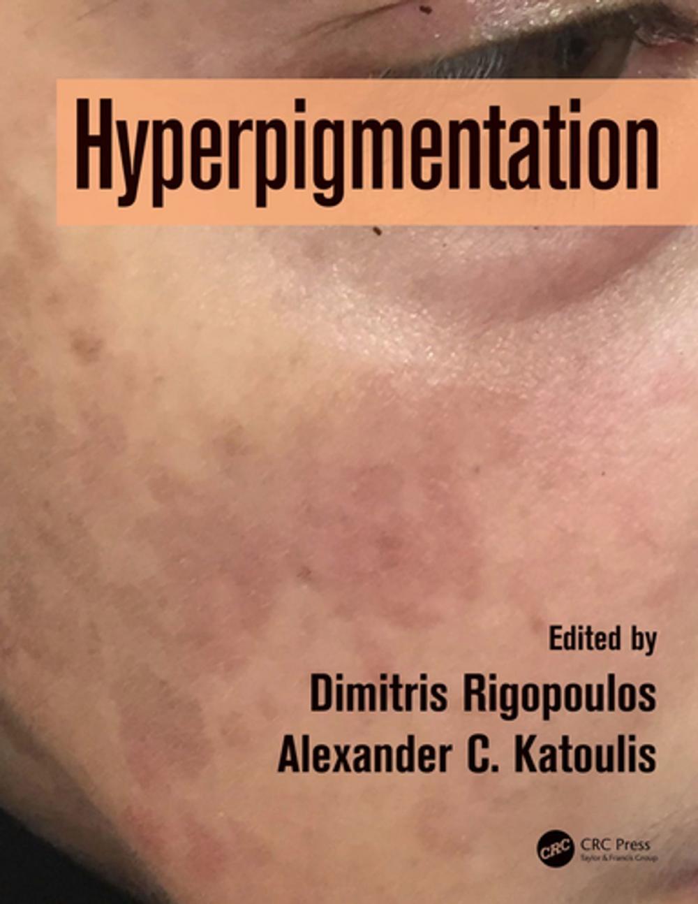 Big bigCover of Hyperpigmentation