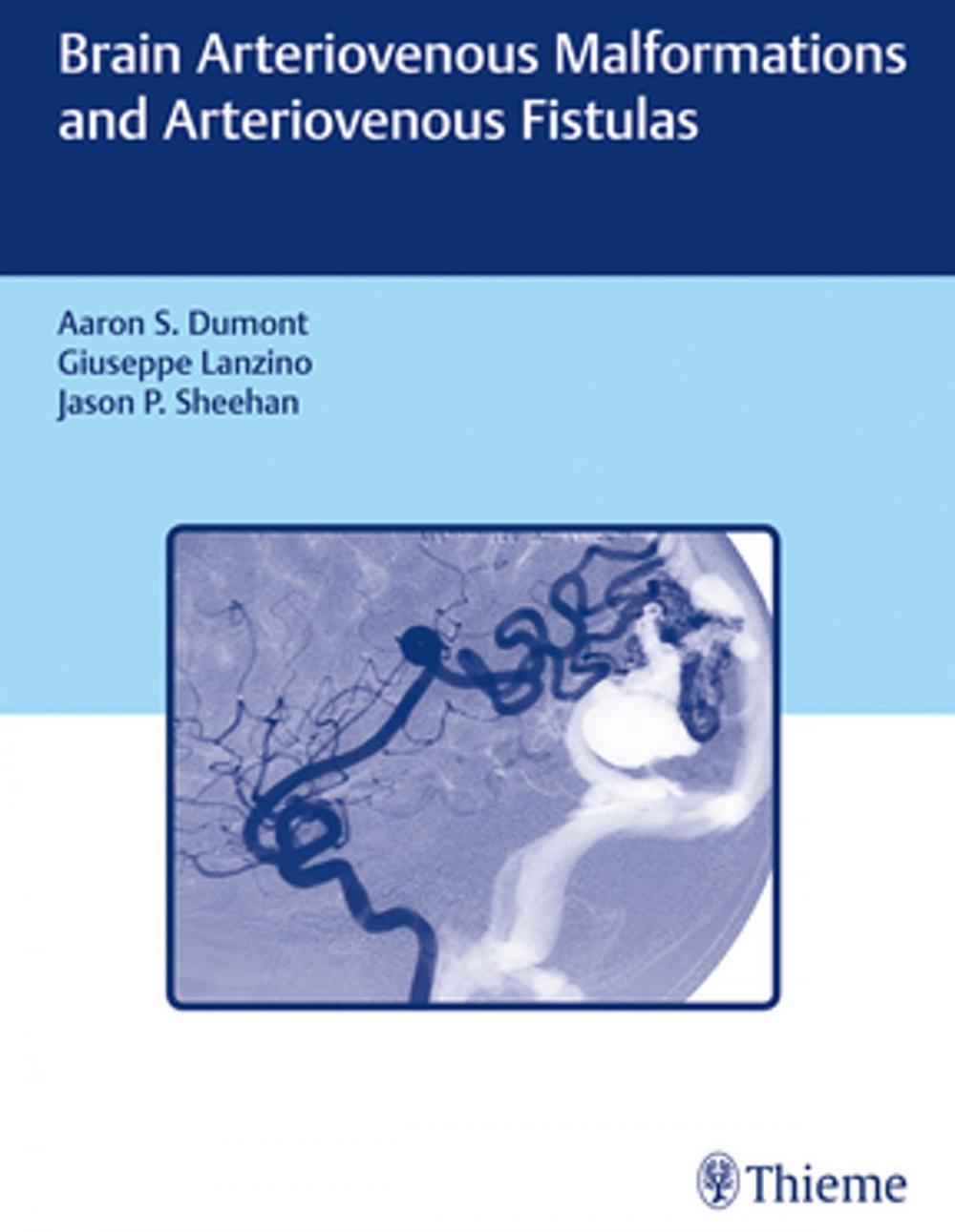 Big bigCover of Brain Arteriovenous Malformations and Arteriovenous Fistulas