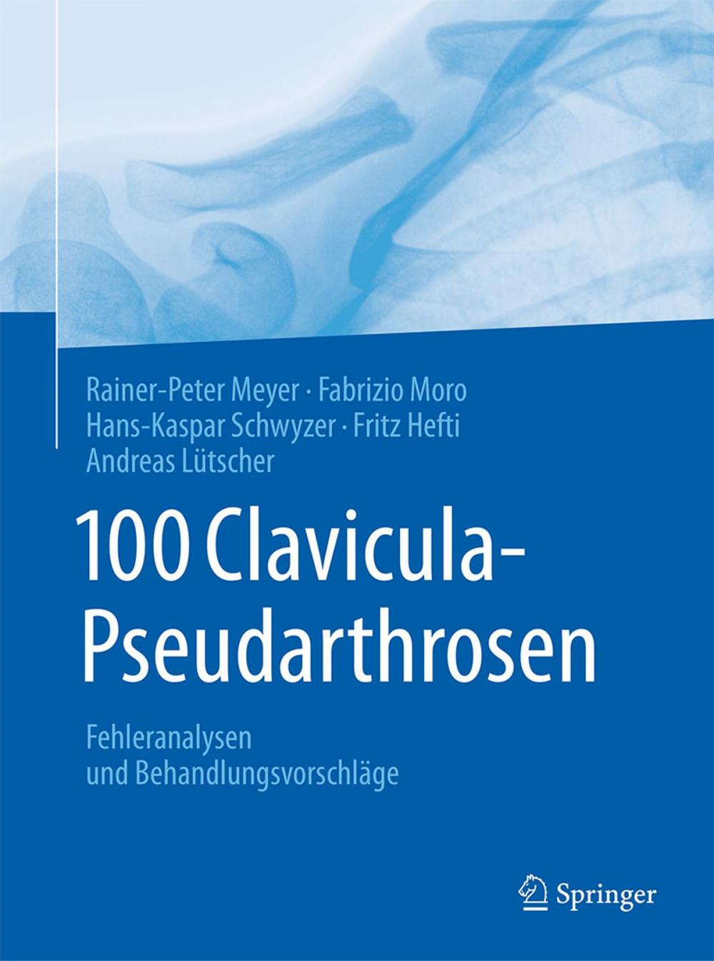 Big bigCover of 100 Clavicula-Pseudarthrosen