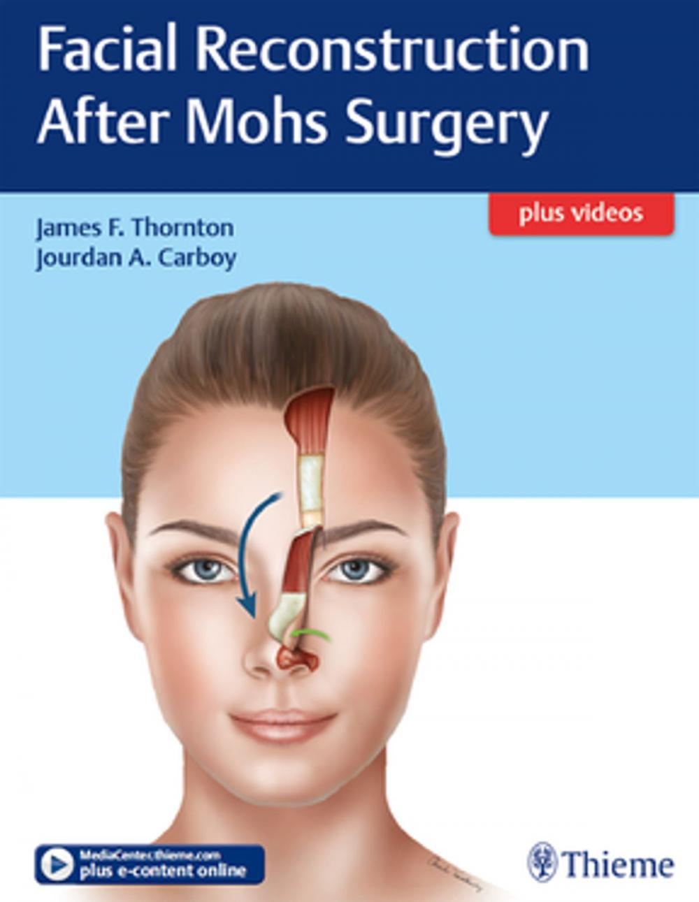 Big bigCover of Facial Reconstruction After Mohs Surgery