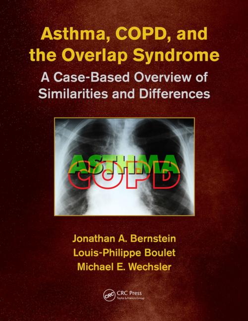 Cover of the book Asthma, COPD, and Overlap by , CRC Press
