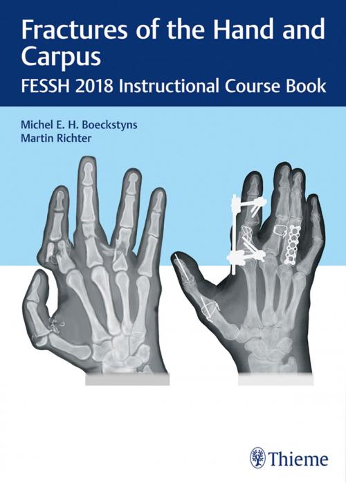 Cover of the book Fractures of the Hand and Carpus by , Thieme