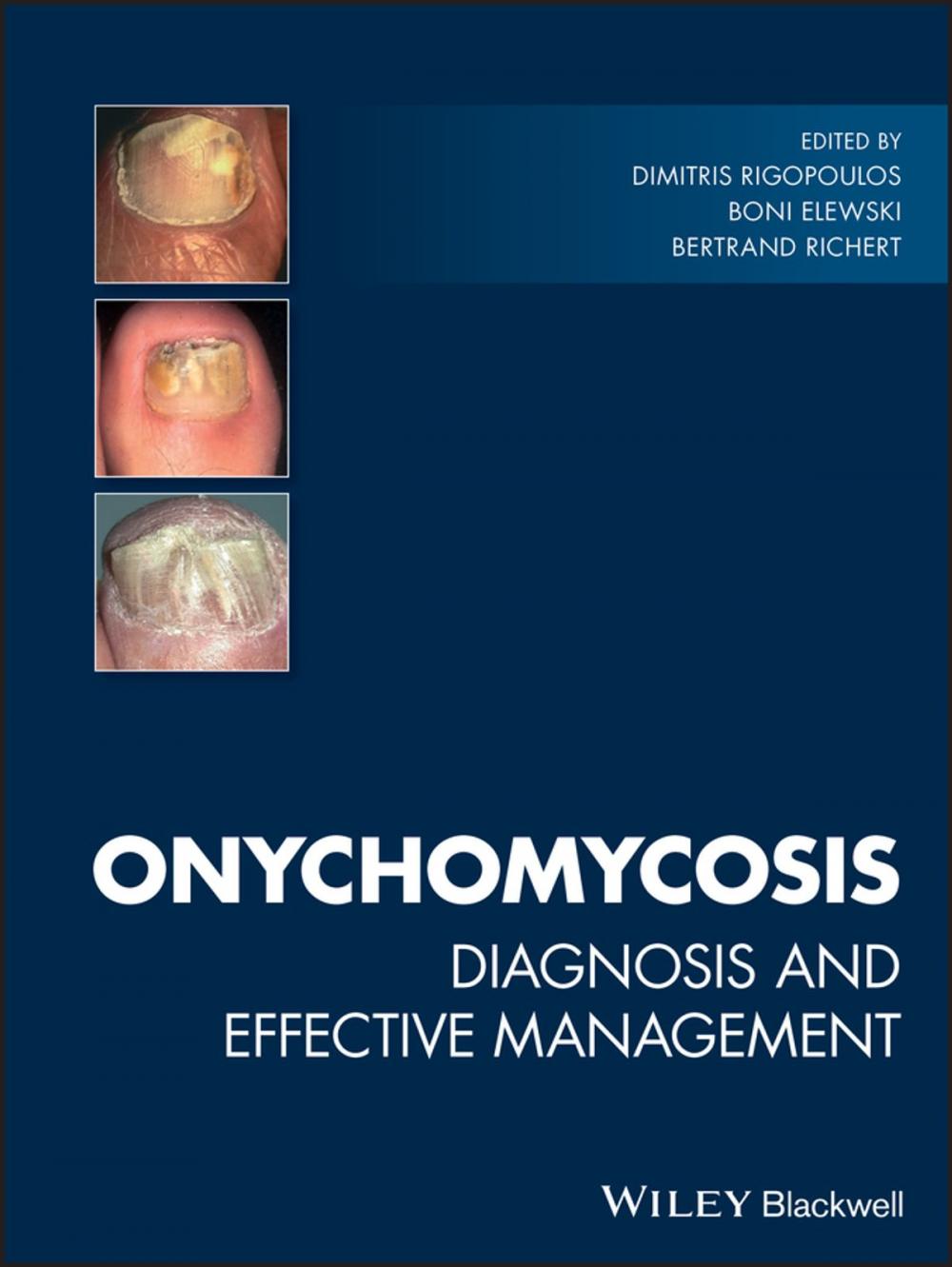 Big bigCover of Onychomycosis